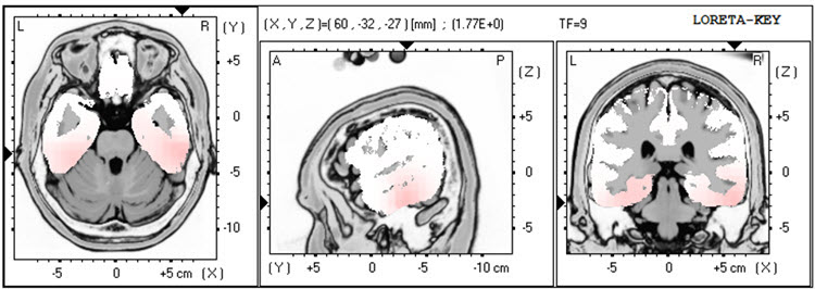 Second recording LORETA at 9 Hz showing minimal excess activity